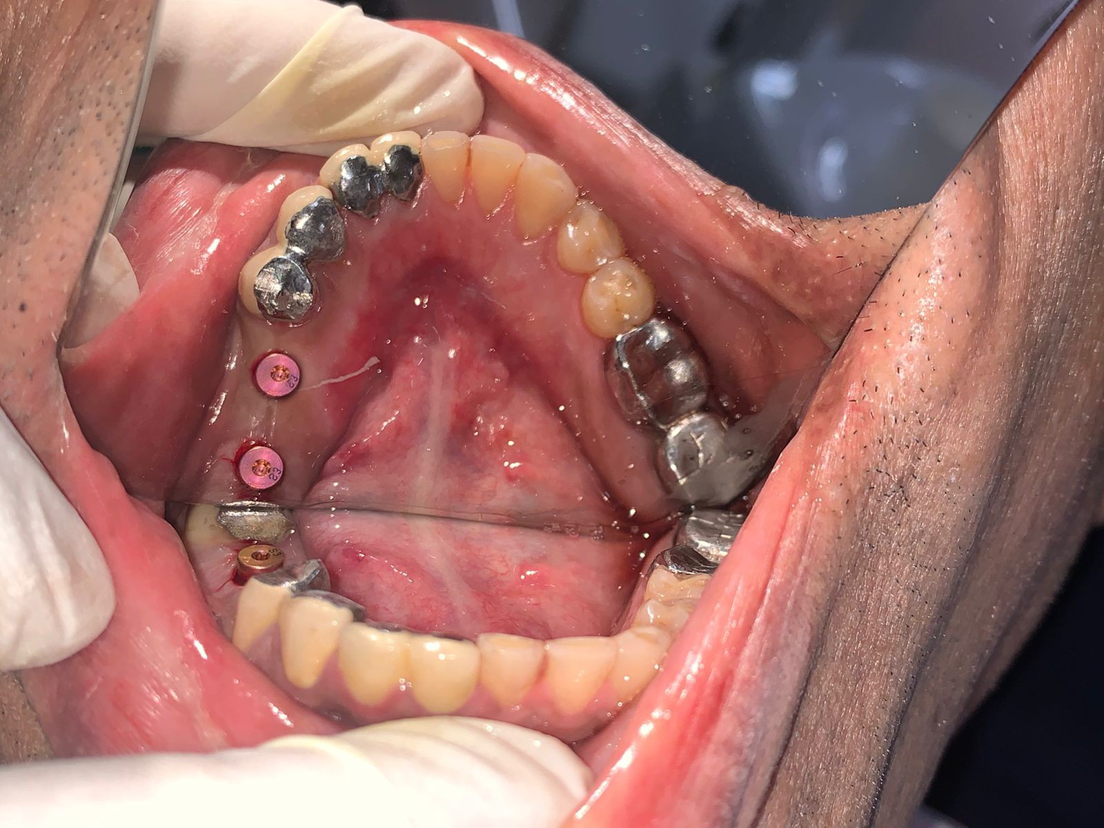 Dental Implant Case
